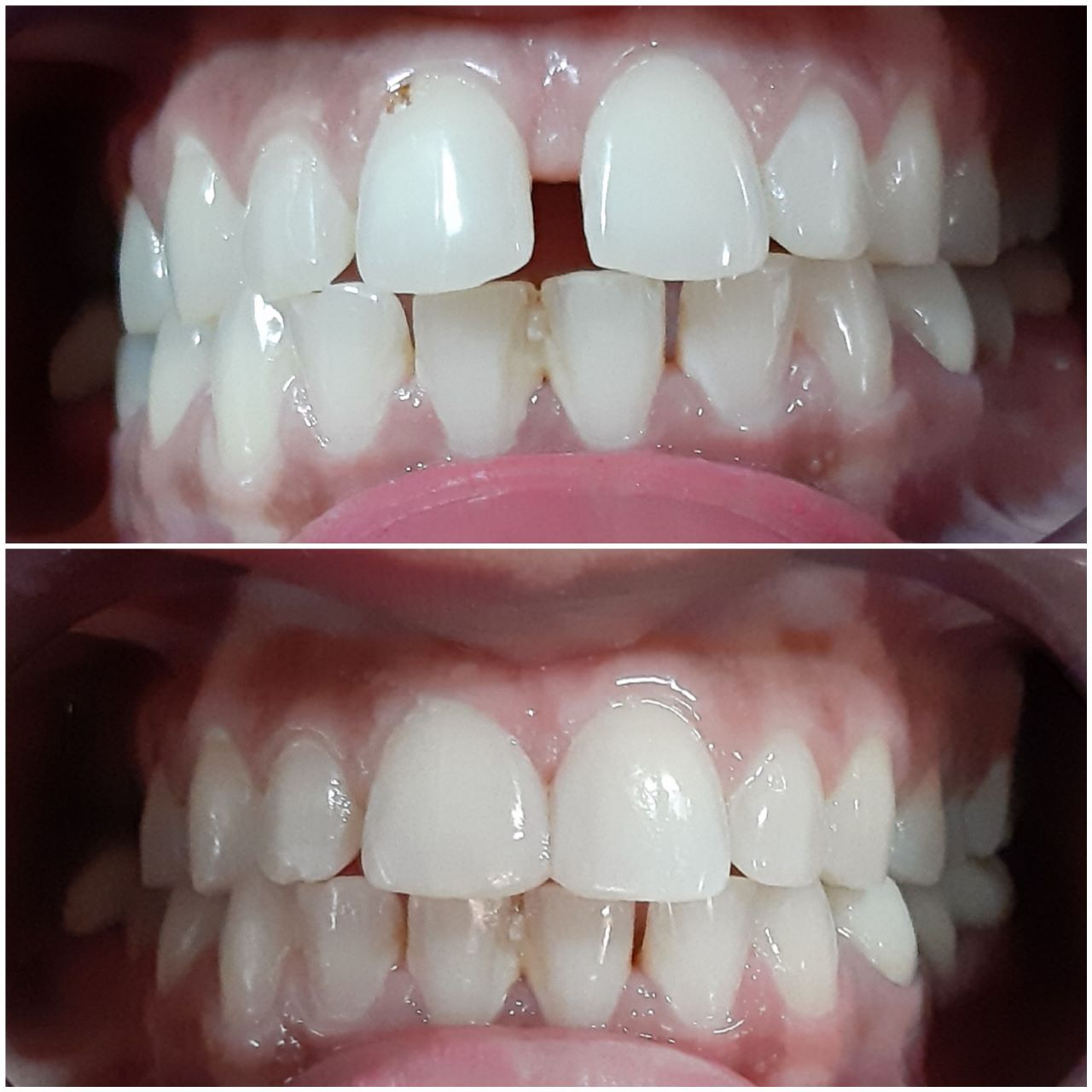 Fix Teeth in Chandigarh