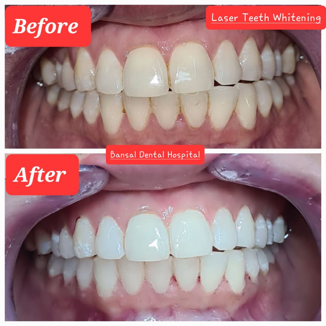 Fix Teeth in Jagadhri