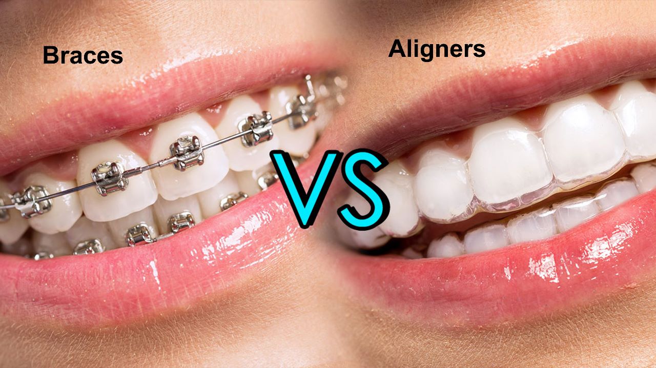 Orthodontic Treatment in Haryana